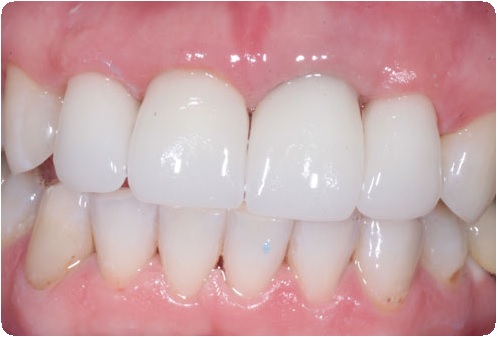 Восстановление переднего зуба5