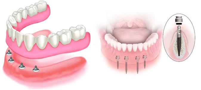 Установка несъемного зубного протеза5