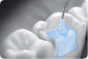 Протокол реставрации зубов5