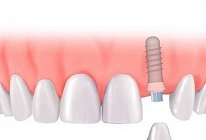 Протезирование одиночных зубов