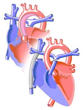 Варианты хирургического лечения легочной артерии5