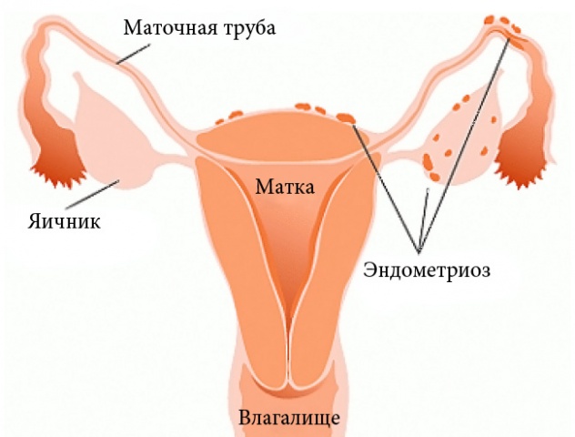 Признаки внематочной беременности35