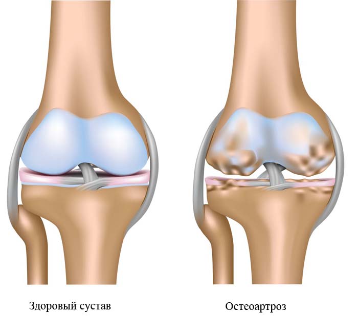 Причины боли в коленном суставе5