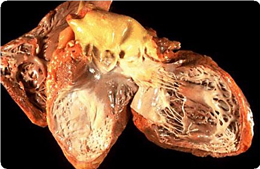 Злокачественная опухоль сердца5