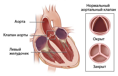 Порок клапана легочной артерии. Врожденный порок КЛА5