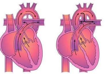 Единственный желудочек сердца5