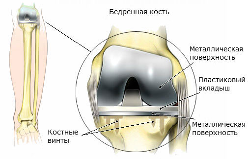 Эндопротезирование коленного сустава6