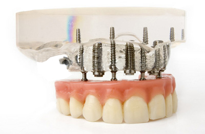 Имплантаты, соединенные с зубами6