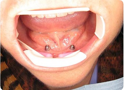 Перекрывающие зубные протезы6
