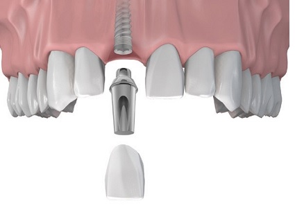 Имплантация верхней челюсти при частичном отсутствии зубов6