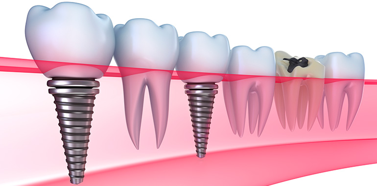 Восстановление всех зубов верхней челюсти6