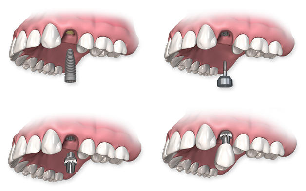 Имплантат верхнего  зуба6