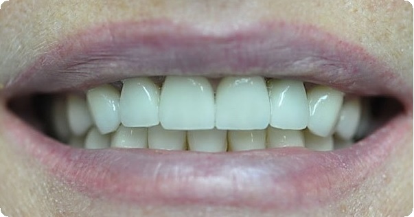 Восстановление переднего зуба6