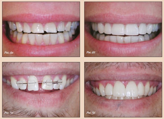 Протезирование одиночных зубов6