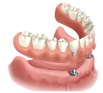 Установка несъемного зубного протеза6