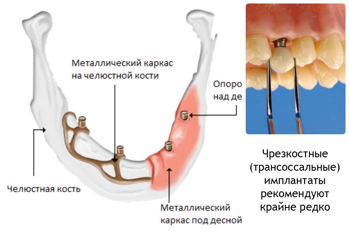 Окклюзия зубных протезов6