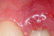 Осложнения при имплантации зубов верхней челюсти