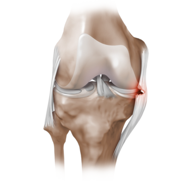 Повреждения связок коленного сустава6