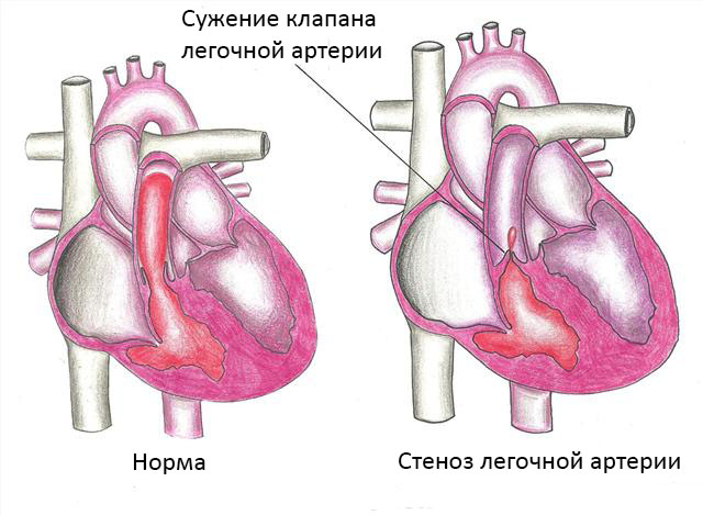 Изолированный клапанный стеноз легочной артерии6