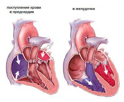 Периферический стеноз легочной артерии6