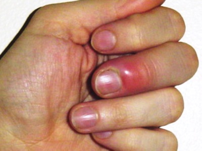 Заусенцы на пальцах рук: причины, лечение, профилактика6