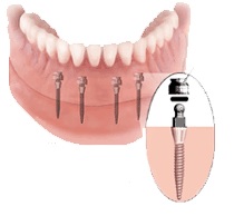 Установка имплантата сразу после удаления зуба6