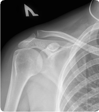 Диафизарные переломы плечевой кости7