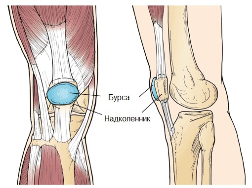 Хондроматоз коленного сустава7
