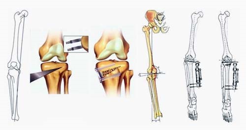 Одномыщелковое эндопротезирование коленного сустава7