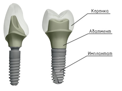 Имплантаты, соединенные с зубами7