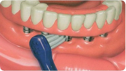 Перекрывающие зубные протезы7