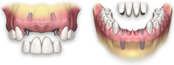 Восстановление всех зубов верхней челюсти7