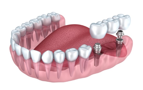 Выбор материала для зубного имплантата7