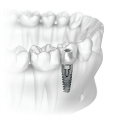 Имплантация одиночных зубов5