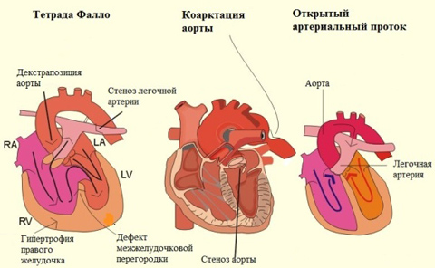 Классификация врожденных пороков сердца7