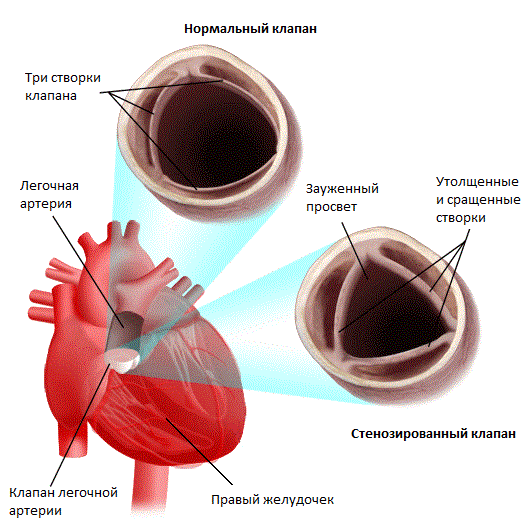 Изолированный клапанный стеноз легочной артерии7