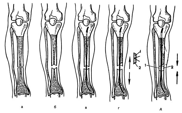 Перелом костей коленного сустава8