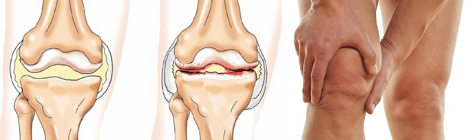 Повреждение мениска коленного сустава8