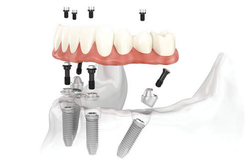 Имплантаты, соединенные с зубами8