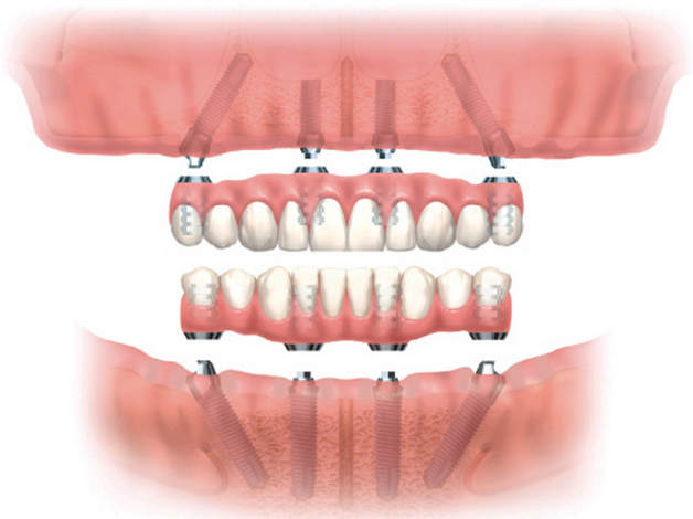 Восстановление всех зубов верхней челюсти8