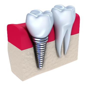 Выбор материала для зубного имплантата8