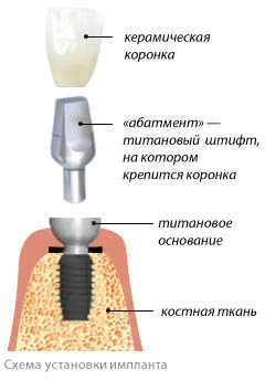 Особенности дизайна зубного имплантата8