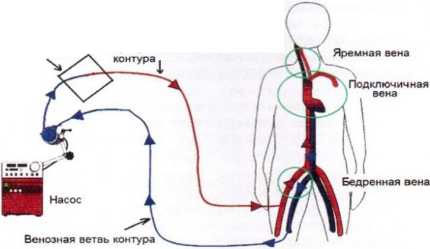 Первичная легочная артериальная гипертензия8
