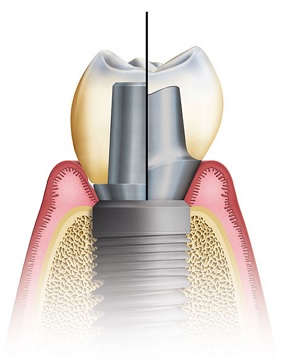 Имплантаты, соединенные с зубами9