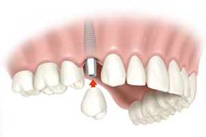 Перекрывающие зубные протезы9