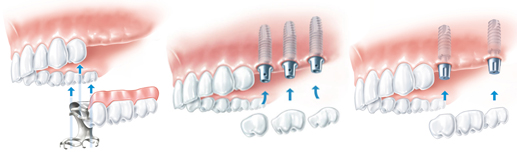 Восстановление всех зубов верхней челюсти9