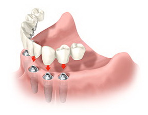 Выбор материала для зубного имплантата9