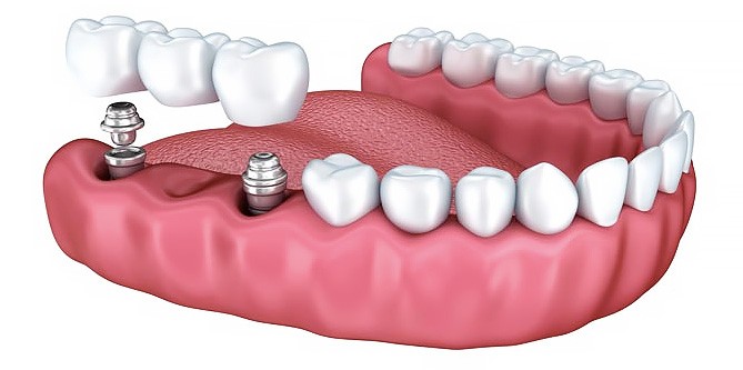 Установка несъемного зубного протеза9