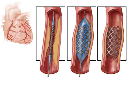 Периферический стеноз легочной артерии9