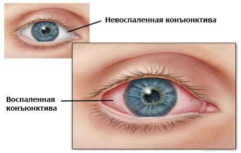 Светобоязнь глаз: причины, симптомы, лечение9